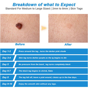 Micro Skin Tag Remover