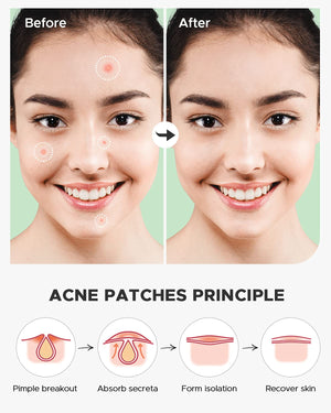 Acne Pimple Patch (180 Counts 4 Sizes), Invisible Hydrocolloid Acne Patch with Tea Tree Oil & Calendula Oil, Acne Spot Healing Patch Zit Patches